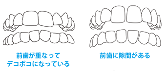 前歯が重なってデコボコになっている　前歯に隙間がある