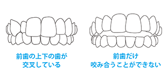 前歯の上下の歯が交叉している　前歯だけ咬み合うことができない