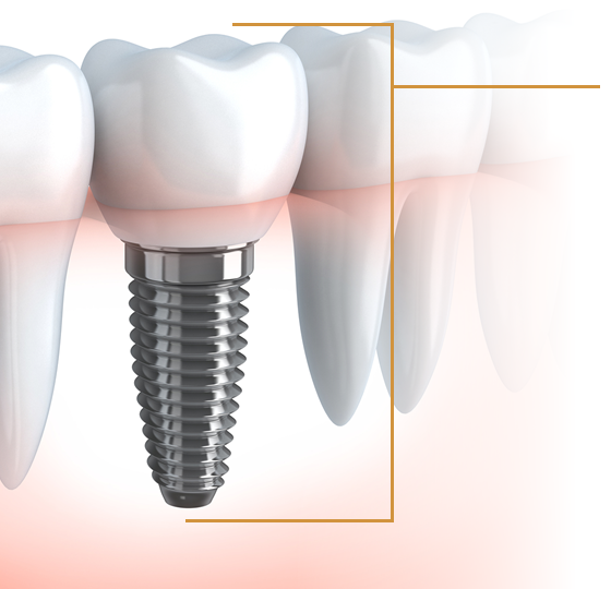 インプラント治療の費⽤